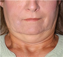 Liposuction Before Photo by Ellen Mahony, MD; Westport, CT - Case 50462