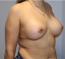 Breast Augmentation After Photo by Ellen Mahony, MD; Westport, CT - Case 50460