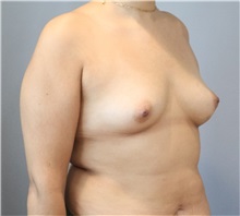 Breast Augmentation Before Photo by Ellen Mahony, MD; Westport, CT - Case 50460