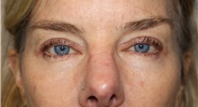 Eyelid Surgery After Photo by Ellen Mahony, MD; Westport, CT - Case 50555