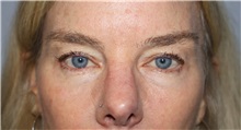 Eyelid Surgery Before Photo by Ellen Mahony, MD; Westport, CT - Case 50555
