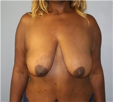 Breast Reduction Before Photo by Ellen Mahony, MD; Westport, CT - Case 50556