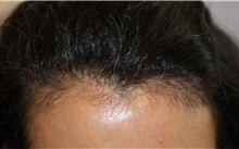 Hair Transplant After Photo by Ellen Mahony, MD; Westport, CT - Case 50761
