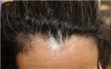 Hair Transplant Before Photo by Ellen Mahony, MD; Westport, CT - Case 50761