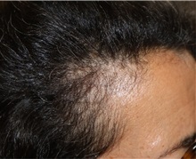Hair Transplant After Photo by Ellen Mahony, MD; Westport, CT - Case 50761