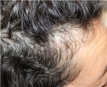 Hair Transplant Before Photo by Ellen Mahony, MD; Westport, CT - Case 50761