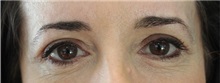 Eyelid Surgery After Photo by Ellen Mahony, MD; Westport, CT - Case 50759