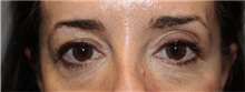 Eyelid Surgery Before Photo by Ellen Mahony, MD; Westport, CT - Case 50759