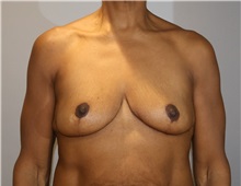 Breast Lift After Photo by Ellen Mahony, MD; Westport, CT - Case 50760