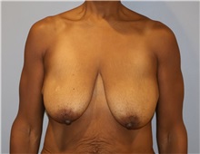 Breast Lift Before Photo by Ellen Mahony, MD; Westport, CT - Case 50760