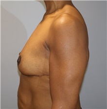 Breast Lift After Photo by Ellen Mahony, MD; Westport, CT - Case 50760