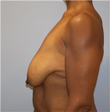 Breast Lift Before Photo by Ellen Mahony, MD; Westport, CT - Case 50760