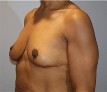 Breast Lift After Photo by Ellen Mahony, MD; Westport, CT - Case 50760