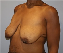 Breast Lift Before Photo by Ellen Mahony, MD; Westport, CT - Case 50760