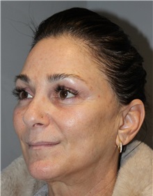 Thread Lift After Photo by Ellen Mahony, MD; Westport, CT - Case 50837