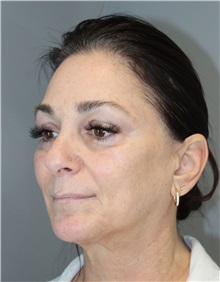Thread Lift Before Photo by Ellen Mahony, MD; Westport, CT - Case 50837