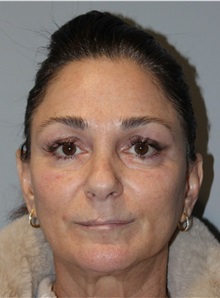 Thread Lift After Photo by Ellen Mahony, MD; Westport, CT - Case 50837