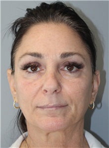 Thread Lift Before Photo by Ellen Mahony, MD; Westport, CT - Case 50837