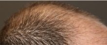 Hair Transplant After Photo by Ellen Mahony, MD; Westport, CT - Case 50836