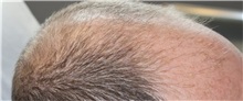 Hair Transplant Before Photo by Ellen Mahony, MD; Westport, CT - Case 50836