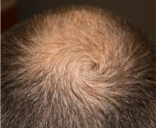 Hair Transplant After Photo by Ellen Mahony, MD; Westport, CT - Case 50836