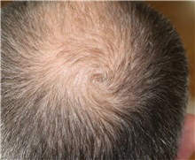 Hair Transplant Before Photo by Ellen Mahony, MD; Westport, CT - Case 50836