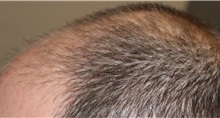 Hair Transplant After Photo by Ellen Mahony, MD; Westport, CT - Case 50836