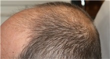 Hair Transplant Before Photo by Ellen Mahony, MD; Westport, CT - Case 50836
