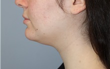 Nonsurgical Fat Reduction After Photo by Ellen Mahony, MD; Westport, CT - Case 50835