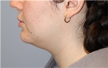 Nonsurgical Fat Reduction Before Photo by Ellen Mahony, MD; Westport, CT - Case 50835