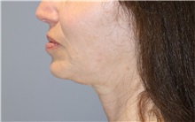Thread Lift After Photo by Ellen Mahony, MD; Westport, CT - Case 50834