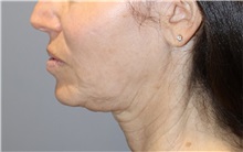 Thread Lift Before Photo by Ellen Mahony, MD; Westport, CT - Case 50834