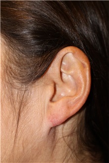 Scar Revision After Photo by Ellen Mahony, MD; Westport, CT - Case 50918