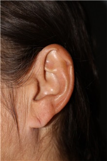 Scar Revision Before Photo by Ellen Mahony, MD; Westport, CT - Case 50918