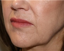 Dermal Fillers After Photo by Ellen Mahony, MD; Westport, CT - Case 50922