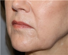 Dermal Fillers Before Photo by Ellen Mahony, MD; Westport, CT - Case 50922