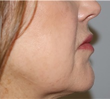 Dermal Fillers After Photo by Ellen Mahony, MD; Westport, CT - Case 50922