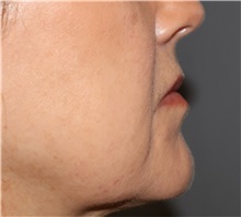 Dermal Fillers Before Photo by Ellen Mahony, MD; Westport, CT - Case 50922