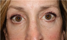 Eyelid Surgery After Photo by Ellen Mahony, MD; Westport, CT - Case 50920