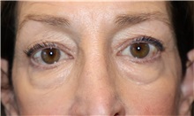 Eyelid Surgery Before Photo by Ellen Mahony, MD; Westport, CT - Case 50920