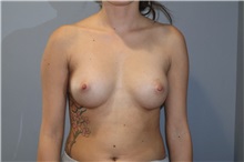 Breast Augmentation After Photo by Ellen Mahony, MD; Westport, CT - Case 50919
