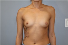 Breast Augmentation Before Photo by Ellen Mahony, MD; Westport, CT - Case 50919