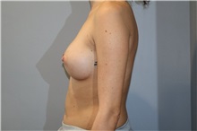 Breast Augmentation After Photo by Ellen Mahony, MD; Westport, CT - Case 50919