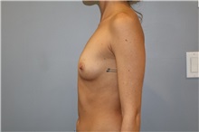 Breast Augmentation Before Photo by Ellen Mahony, MD; Westport, CT - Case 50919