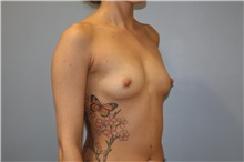 Breast Augmentation Before Photo by Ellen Mahony, MD; Westport, CT - Case 50919