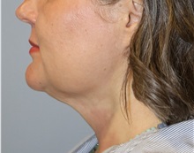 Liposuction After Photo by Ellen Mahony, MD; Westport, CT - Case 51089