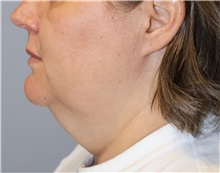 Liposuction Before Photo by Ellen Mahony, MD; Westport, CT - Case 51089
