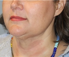 Liposuction After Photo by Ellen Mahony, MD; Westport, CT - Case 51089
