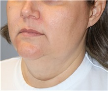 Liposuction Before Photo by Ellen Mahony, MD; Westport, CT - Case 51089