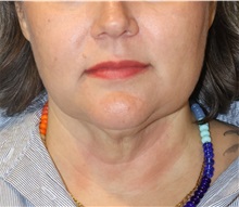 Liposuction After Photo by Ellen Mahony, MD; Westport, CT - Case 51089